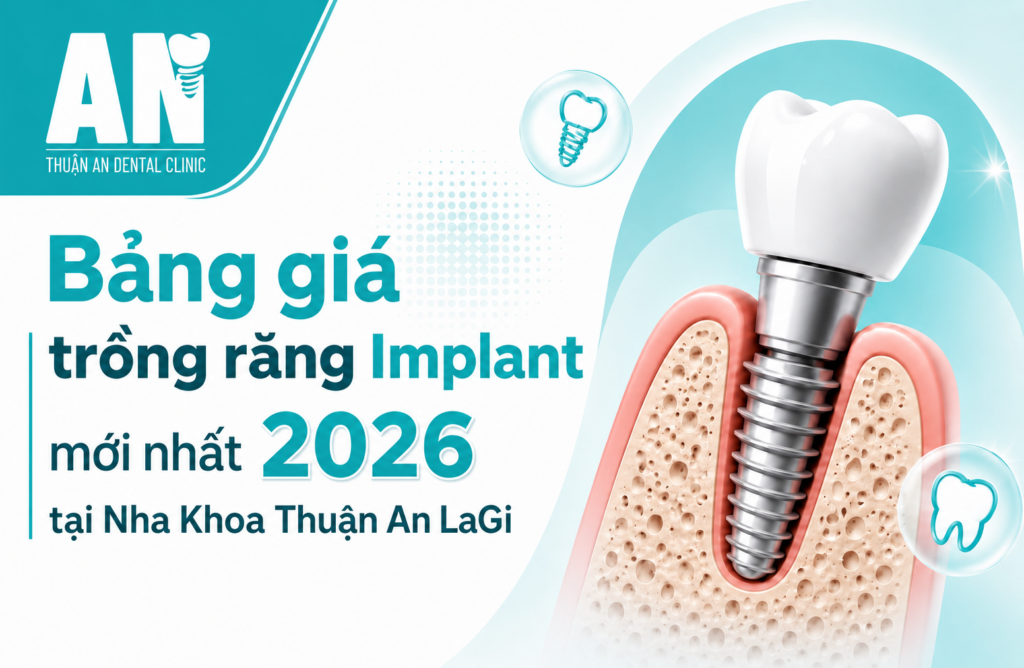 Bảng giá trồng răng Implant mới nhất 2026 tại Nha Khoa Thuận An LaGi