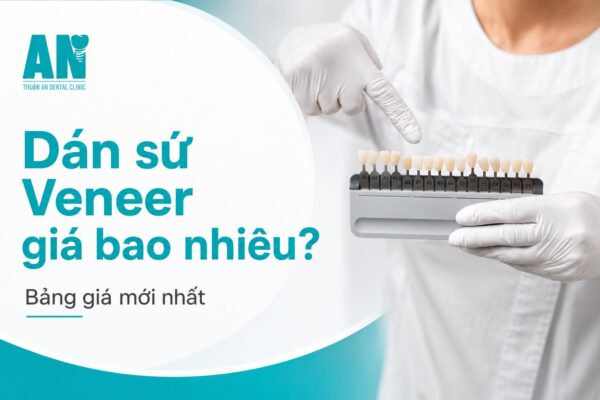 Dán sứ Veneer giá bao nhiêu? Bảng giá mới nhất