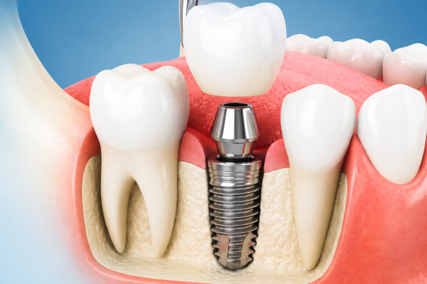 Trồng răng Implant