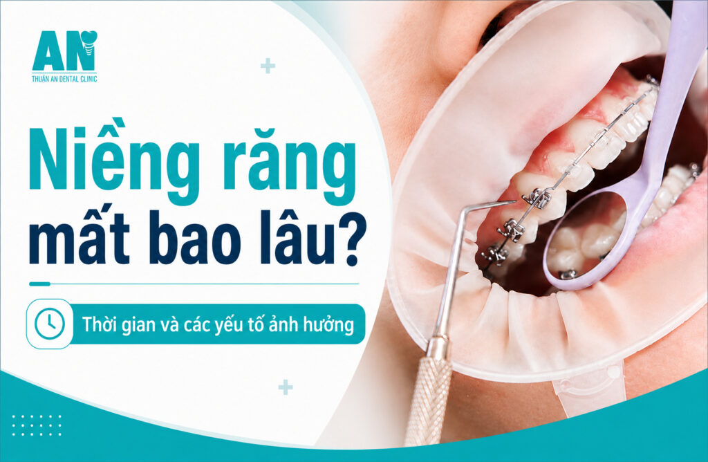 Niềng răng mất bao lâu? Thời gian và các yếu tố ảnh hưởng