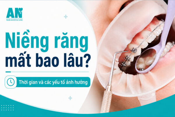 Niềng răng mất bao lâu? Thời gian và các yếu tố ảnh hưởng